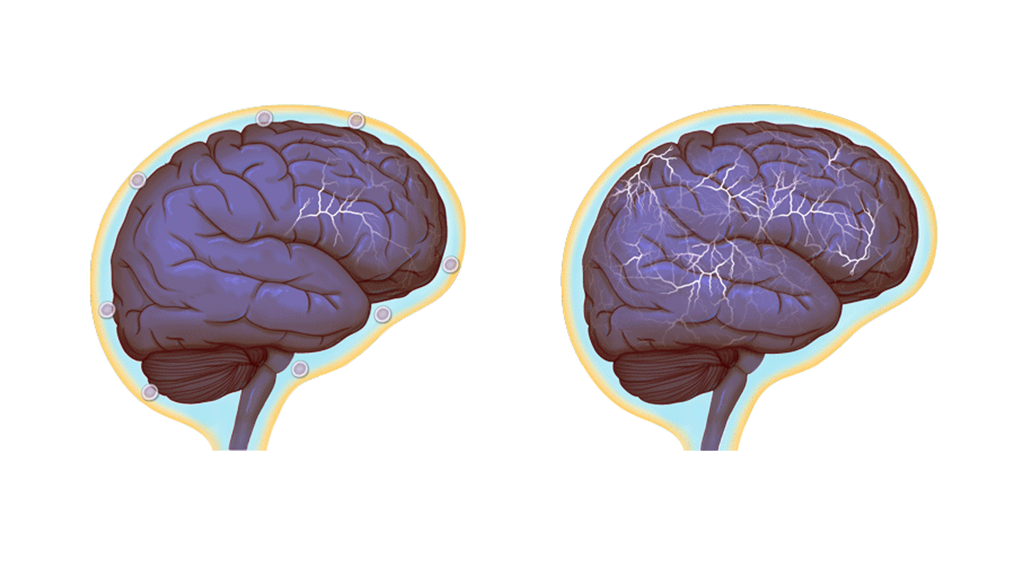 Images of normal brain activity, left, and of a hyper-connected brain. (Images by Anita Impagliazzo, UVA Health System)